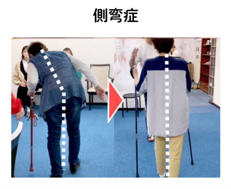 側弯症の姿勢改善の様子